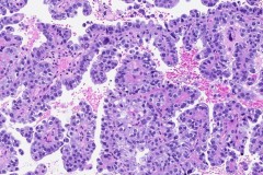 Clear cell carcinoma of the uterus