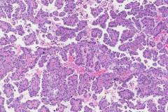 Clear cell carcinoma of the uterus