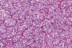 Clear cell renal cell carcinoma