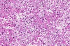 Metastatic clear cell renal cell carcinoma to the adrenal gland