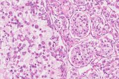 Clear cell renal cell carcinoma