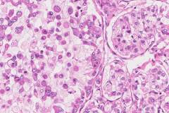 Clear cell renal cell carcinoma