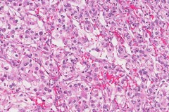 Clear cell renal cell carcinoma