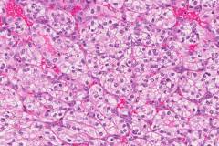 Clear cell renal cell carcinoma