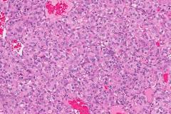 Clear cell renal cell carcinoma