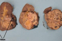 Clear cell renal cell carcinoma