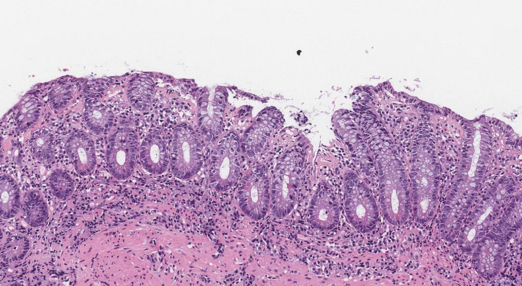 Collagenous colitis | Atlas of Pathology