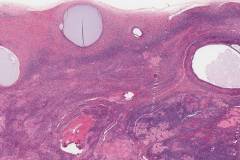 Cortical inclusion cysts of the ovary