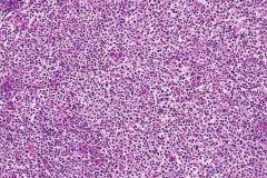 Cutaneous follicular lymphoma