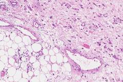 Dedifferentiated liposarcoma