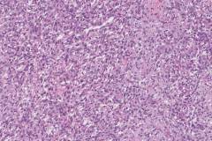 Dedifferentiated liposarcoma