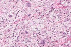 Dedifferentiated liposarcoma