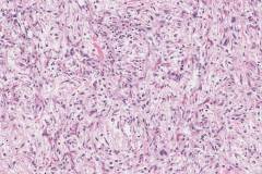 Dedifferentiated liposarcoma