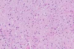 Dedifferentiated liposarcoma