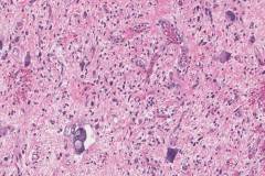 Dedifferentiated liposarcoma