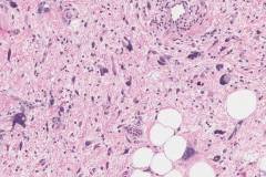 Dedifferentiated liposarcoma