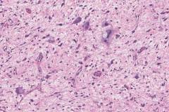 Dedifferentiated liposarcoma