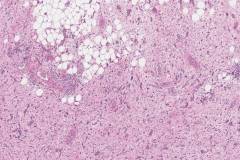 Dedifferentiated liposarcoma arising from a well differentiated liposarcoma