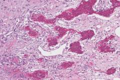 Dedifferentiated liposarcoma with osteosarcomatous differentiation