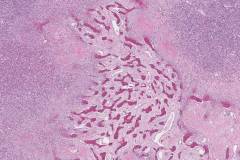 Dedifferentiated liposarcoma with osteosarcomatous differentiation