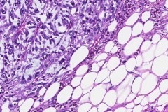 Dedifferentiated liposarcoma with features of pleomorphic sarcoma