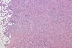 Deep fibrous histiocytoma