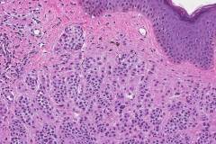 Dermal nevus