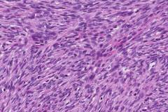 Dermatofibrosarcoma protuberans