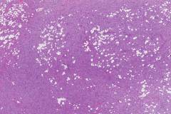 Dermatofibrosarcoma protuberans