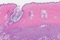 Dermatofibrosarcoma protuberans