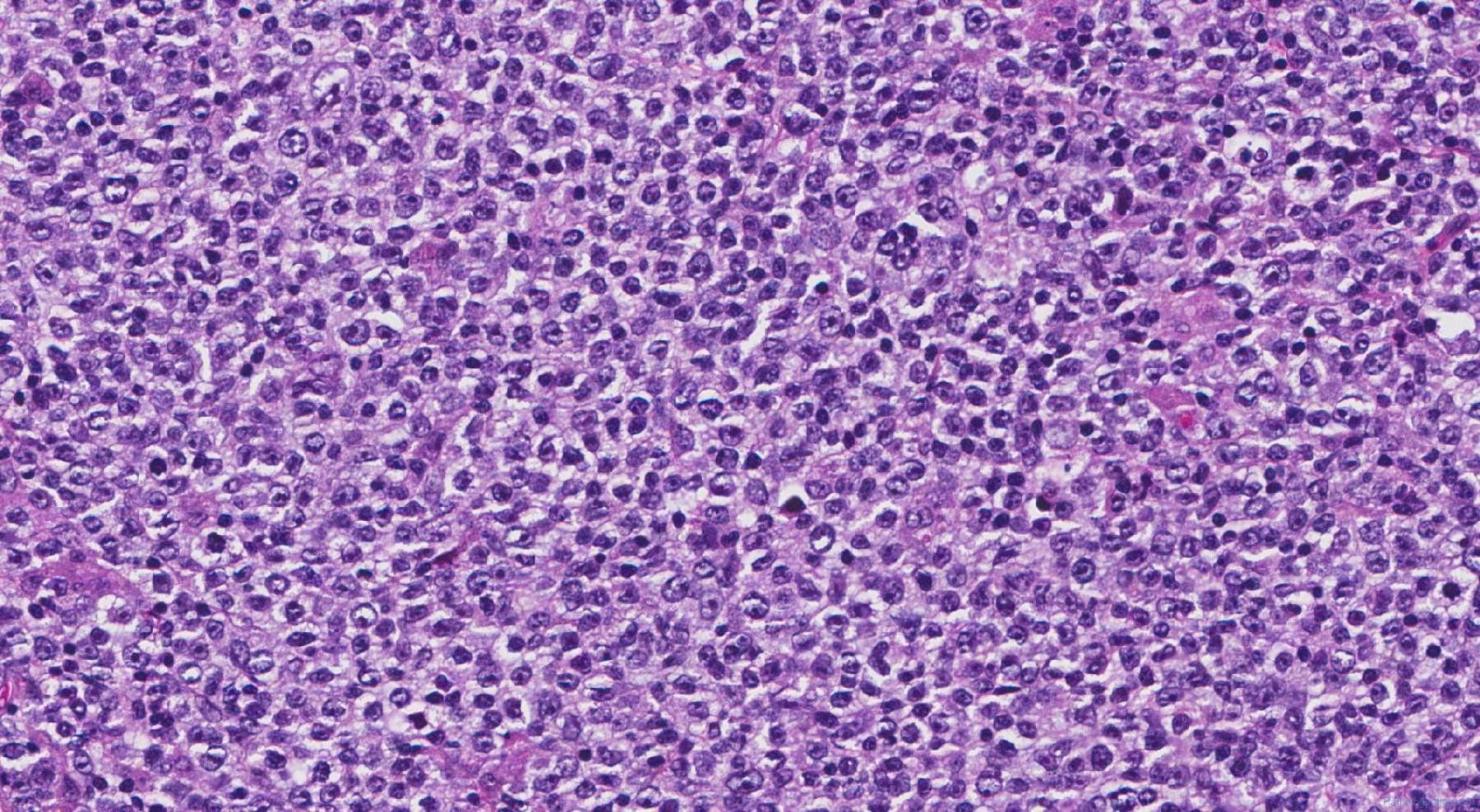 Diffuse Large B Cell Lymphoma Ottawa Atlas Of Pathology