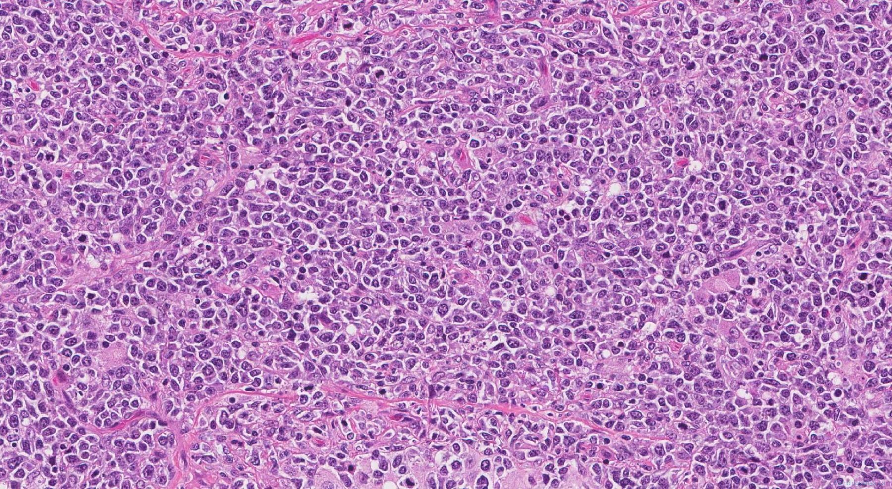 Diffuse large B cell lymphoma | Ottawa Atlas of Pathology