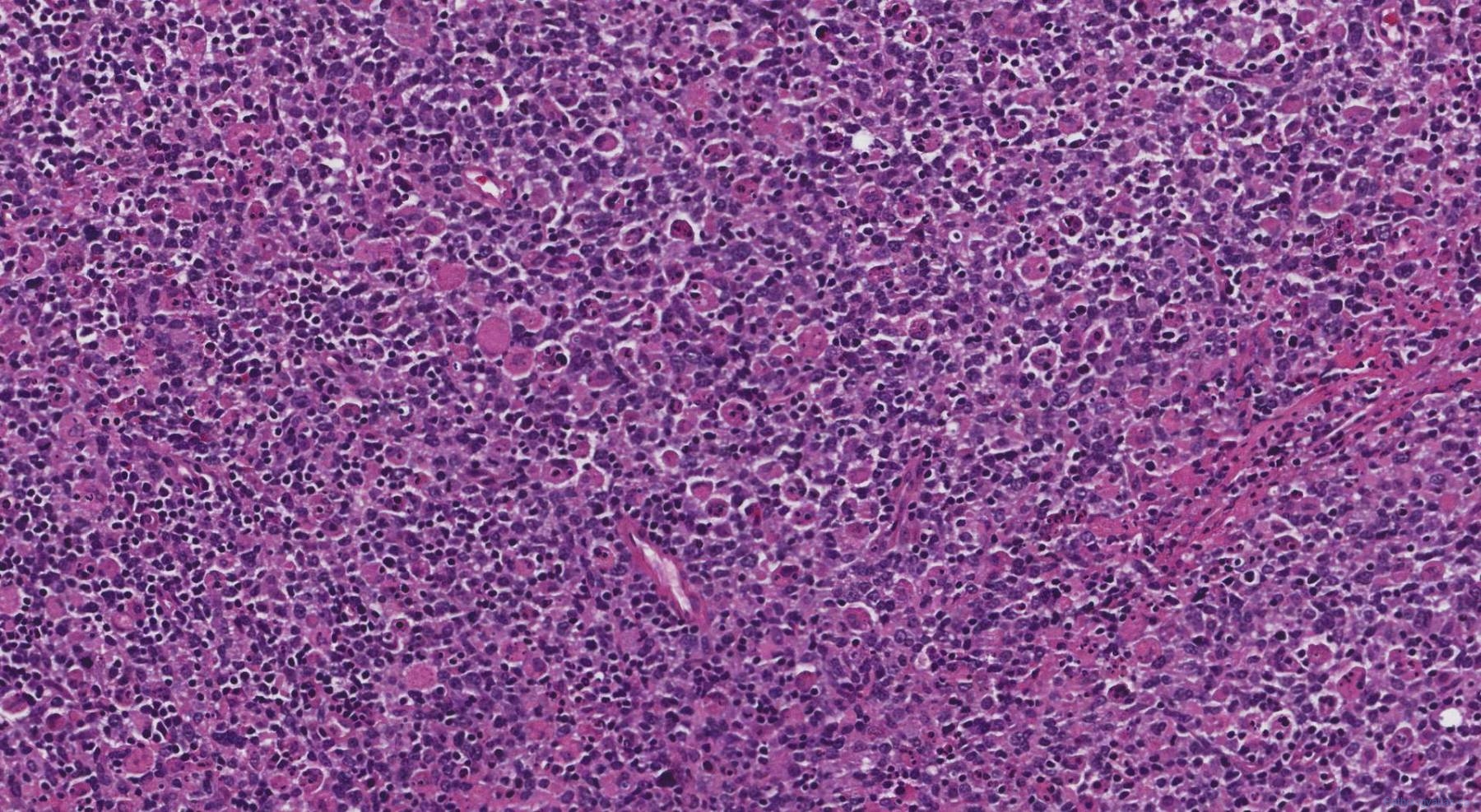 Diffuse Large B Cell Lymphoma | Ottawa Atlas Of Pathology