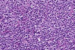 Diffuse large B cell lymphoma