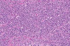 Diffuse large B cell lymphoma in the testis