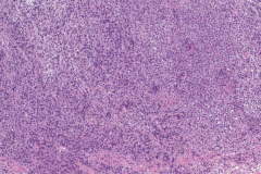 Diffuse large B cell lymphoma in the oropharynx