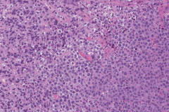 Diffuse large B cell lymphoma in the oropharynx