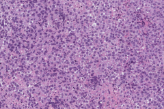 Diffuse large B cell lymphoma in the oropharynx