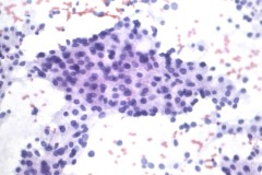 Acinar cell carcinoma