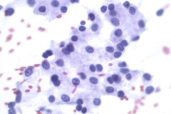 Acinar cell carcinoma