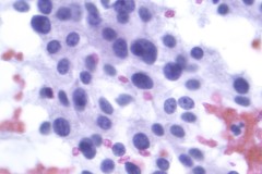 Acinar cell carcinoma