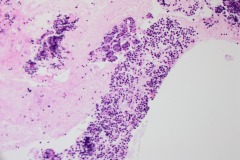 Well differentiated neuroendocrine tumour