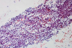 Well differentiated neuroendocrine tumour