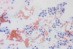 Well differentiated neuroendocrine tumour