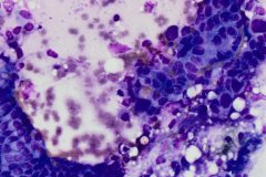 Pancreatic adenocarcinoma