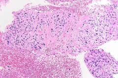 Pancreatic adenocarcinoma