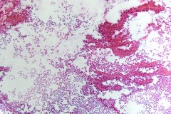 Solid pseudopapillary neoplasm of the pancreas