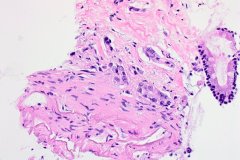 Pancreatic adenocarcinoma