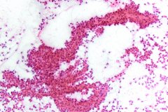 Solid pseudopapillary neoplasm of the pancreas