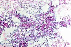 Solid pseudopapillary neoplasm of the pancreas